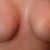 Almost 6 weeks post op
