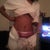 3 days post op