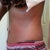 side view 5 weeks post op
