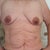 pre-op front view