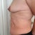 pre-op side view