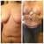 Before and 2 months post op TT and BA