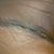 close up of left side of my incision 4 day post op