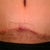 Post Op Day 54 A very small "hole" has opened up and feeling some of the dissolvable stitches poking through the front center of the incision - not long enough for me to trim with scissors.