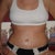 16 days Post OP
