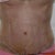 One week post-op--a little more bruised and swollen