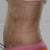 One week post-op--you can see all the marks from the binder