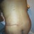 Day 2 my backside. Sorry about the butt shot but my back looks good. Very swollen. Full of fluid. But no more flaps of fat at the bra line