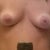 before: droopy breast tissue, large areolas. and chicken cutlets! :""""""(