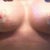 AFTER- 3 WEEKS POST OP, ANOTHER VIEW FROM FRONT. Again, you can see some indentations from the bra in some spots, which may look like stretch marks, but they are from swelling. Please stay perky, Girls!!!