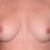 Pre-op pic for reference, old ones got deleted. Size 32 B on left/32 C right.