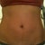4 weeks post procedure