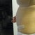 here you can see the bulge above belly button