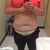 About two months after treatment. So far, I've had two on the upper abdomen and two on the lower. I will post side views very soon! The photos are on my old phone, so I have to pull the memory card.
