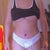 1 week post op