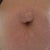 Damn hernia up close