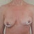 6 Days Post Op...changing a little bit each day, Lots of thick scar tissue removed from left side. Naturally asymetrical and decided to keep it naturally this way as I do not want more scars on breasts.