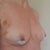 Angle view 6 Days Post Op, Brusing still apparent..does not hurt. Left side will be a bit smaller than right naturally. (as with prior implants) Improving day by day. I am Happy!!!