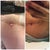 this was the before and after of my wound (as of yesterday)