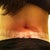 1 wk PO - swelling