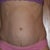 5 months--see the bulge? It is not flat anymore!