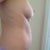pre-op