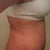 Week 1 post op