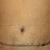 3 weeks post op...drying up nicely... About to start the scar therapy...