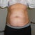 Pre-surgery