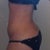 5 weeks Post Op :D