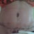 4 days post op
