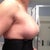 3 day post op