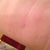 Lipo incision on left flank - Post Op Day 28.  It's the mark in the middle of the screen - the lines on my torso are from the damn binder!