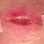 Part of incision that's still not drying out properly.  I have three of these in total along the incision.   There are two that look like this - about a centimeter in circumference, and then I have an area along the incision that is a very thin line that is about 3 centimeters long.  They are improving, but they're taking their sweet time!