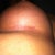 Left incision