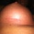 Right incision