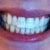 Bite (no aligners) 3/4 way through