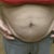 I dieted before my surgery.  Down 10lbs, and the flabby 'wings appeared.  A few years back I lost 20lbs and the flab was worse!