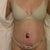 5 days post op.  Does not look that good, I still tuck my tail under, I presume when I am completely upright the results will look better.