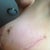 post op day 23, left breast. That bruise appeared about a week ago and is slowly fading. My incision is healing and the lateral point, under my arm, is softening.