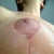 post op day 23. This is the open spot under my left areola, aka scary spot number 2. It's healing, but I still wonder if there's a dissolvable suture in there. We'll see what the PS thinks on Wednesday.