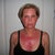 Day 7 and this is the first day that I can kinda agree with the idea of "feels like a sunburn"  This is a very intense healing process.