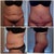 Before and post op day 18!
