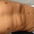 11 weeks post surgery. The swelling is going down and it is starting to look better and better. It's making me even more determined to eat well and make sure not to put weight back on.