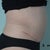 I can barely breath from swelling from PMS.  I am 1 month here