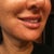 This is my "good" side - the only smile I have left. Taken 10 days after injections. on 9/30/11