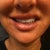 This is my full smile.  How distorted. Taken 10 days after injections.