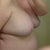 Side before Surgery (Feb 2013). You can see the implants sitting at the top of the breast.