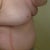 Side following surgery - you can see the drainage tubes. They now look like a typical 57 year old woman's breast. I'm pleased.