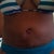 Close up 1 month. You can see the extra skin on your left but my incision looks great!